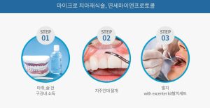 치아재식술 과정