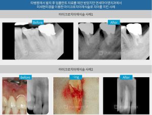 치아재식술 사례