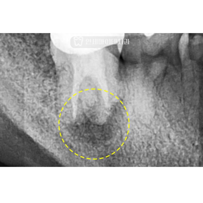 재신경치료 2년 증례: 발치 진단 받았을 때