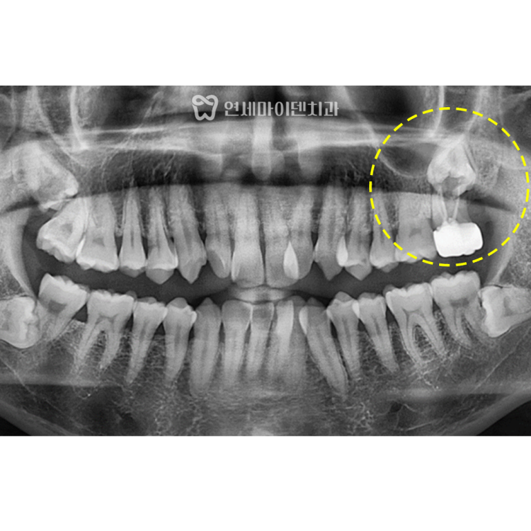 고난이도 임플란트 증례: 매복사랑니 발치와 보존술