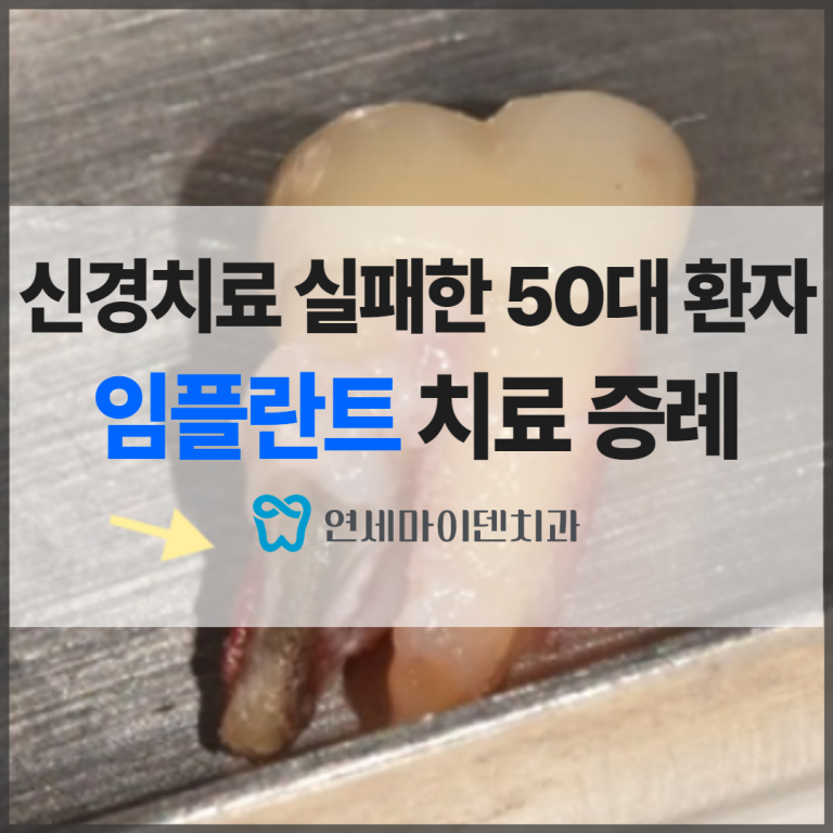 재신경치료까지 실패했다면? 임플란트 선택 기준