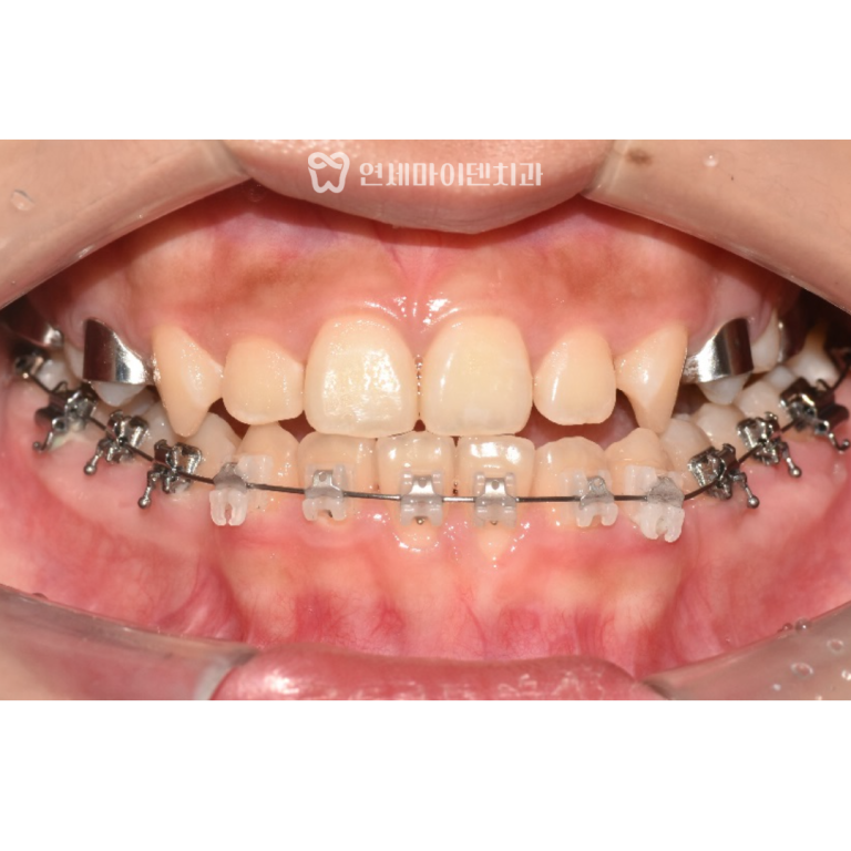 비발치 교정 증례: 안면비대칭 반대교합