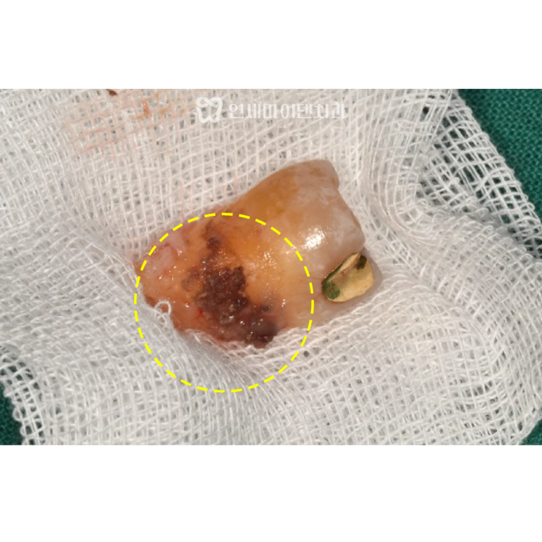 발치 즉시 임플란트 증례: 4개월 완성