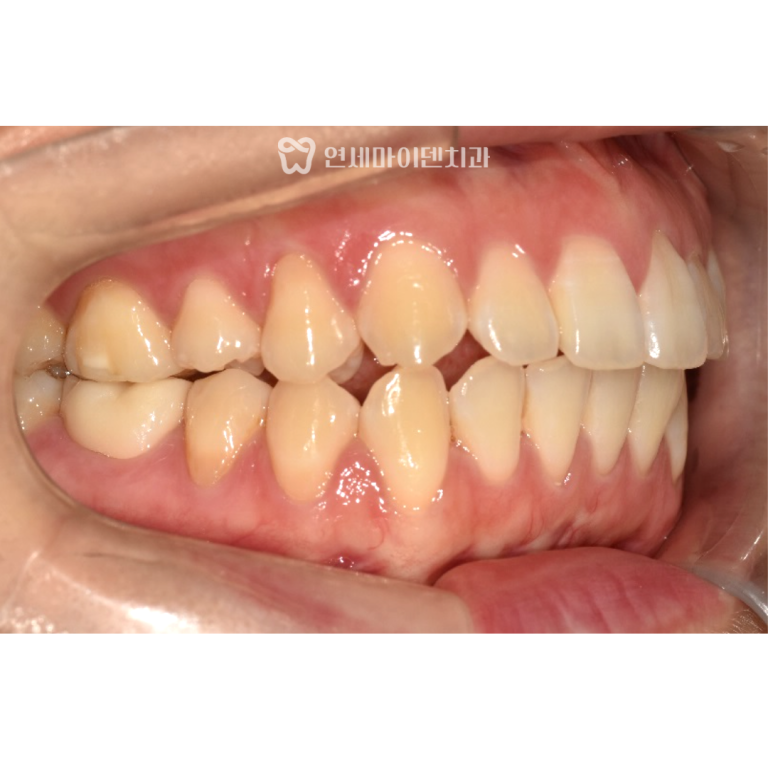 안면비대칭 치아교정 증례: 턱관절 질환 환자