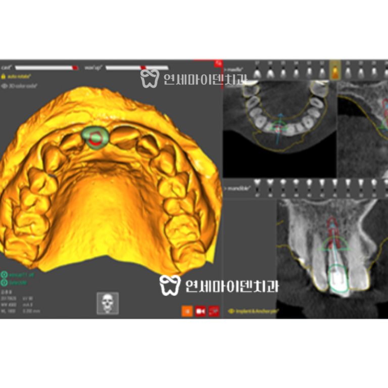 3D 네비게이션 임플란트 증례: 미세현미경