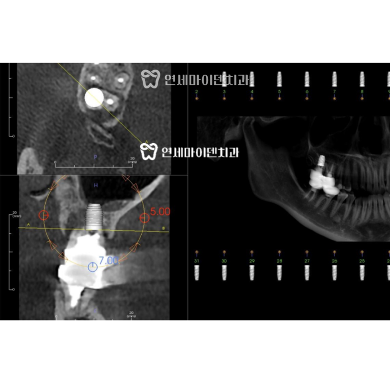 발치 즉시 임플란트 증례: 상악동 수술