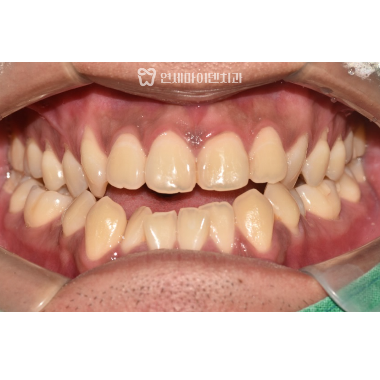 양악수술 치아교정 증례: 주걱턱 교정