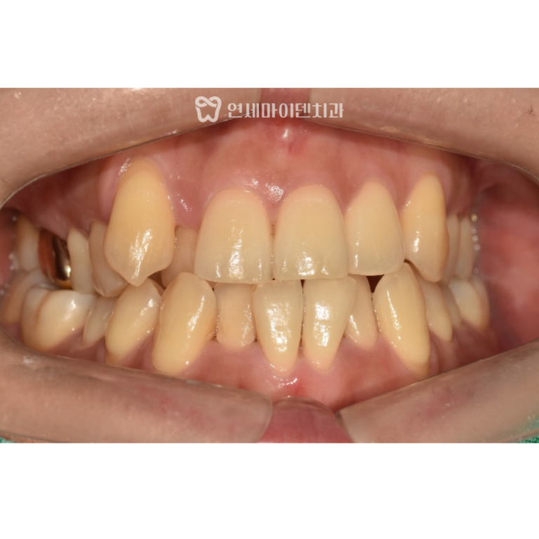30대 비발치 교정 증례: 부정교합, 덧니