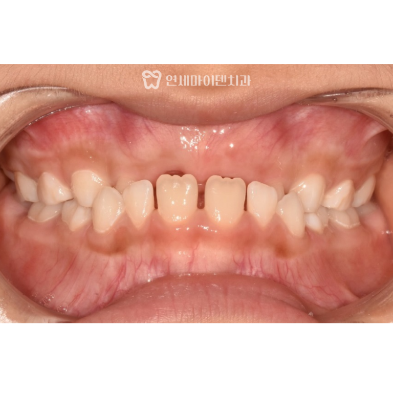 어린이 치아교정 증례: 프리올소 주걱턱 교정