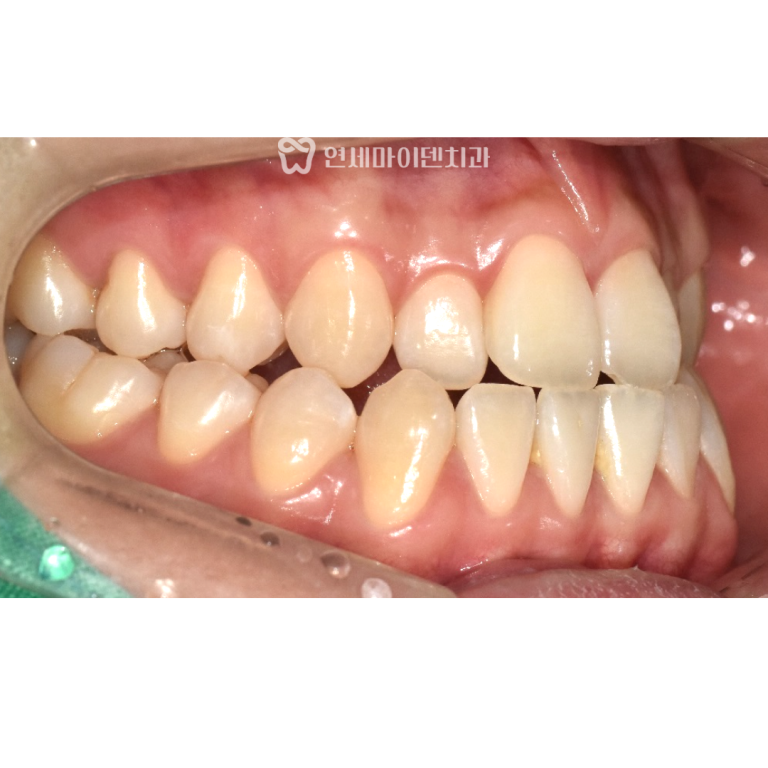 비수술 치아교정 증례: 주걱턱 3급 부정교합