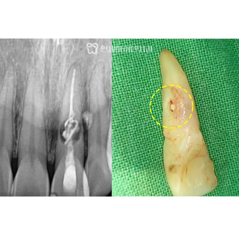 앞니 임플란트 증례: 치근 내흡수