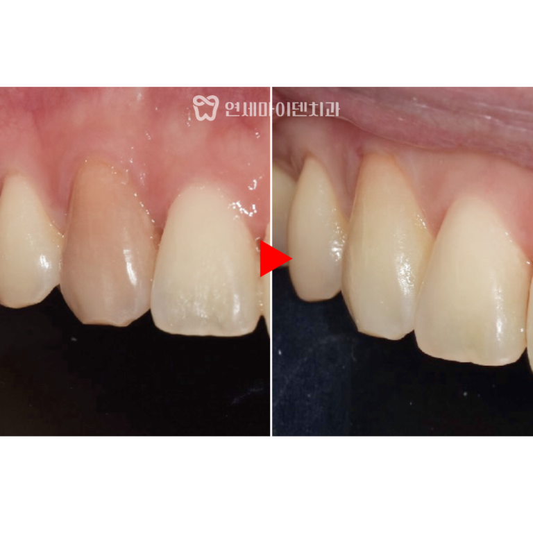 신경치료 증례: 변색 치아 실활치 미백