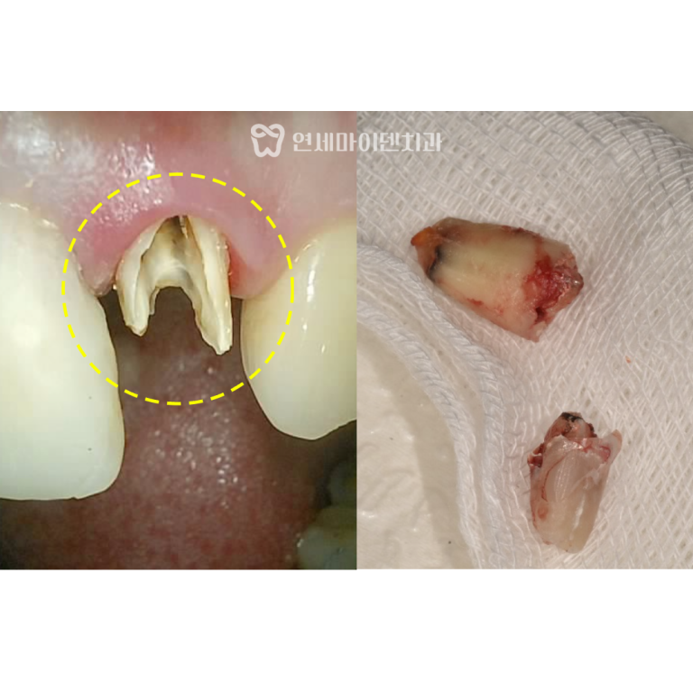 앞니 임플란트, 재신경치료 증례: 치근단절제술 실패