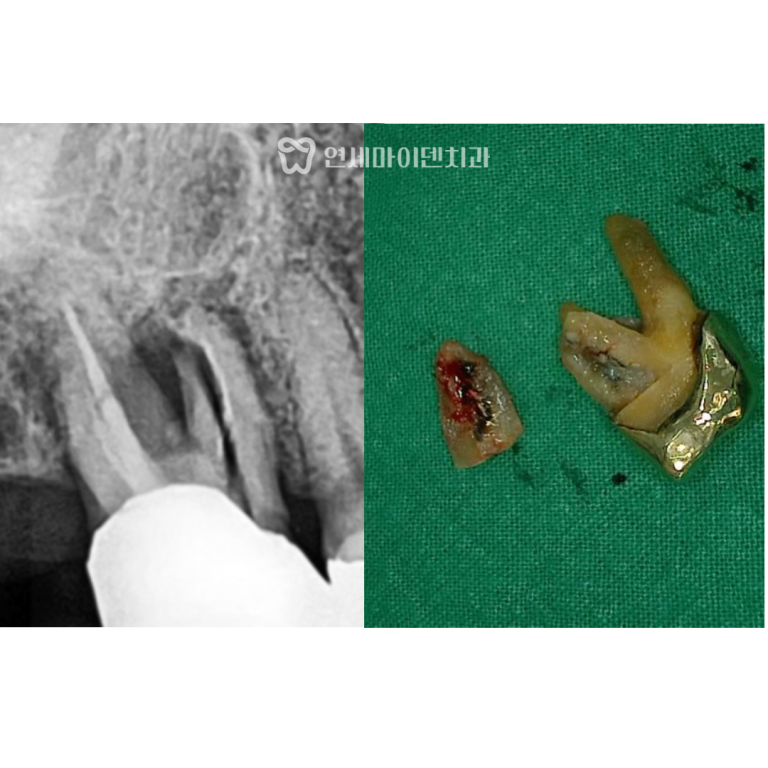 고난이도 임플란트 증례: 50대 잇몸염증