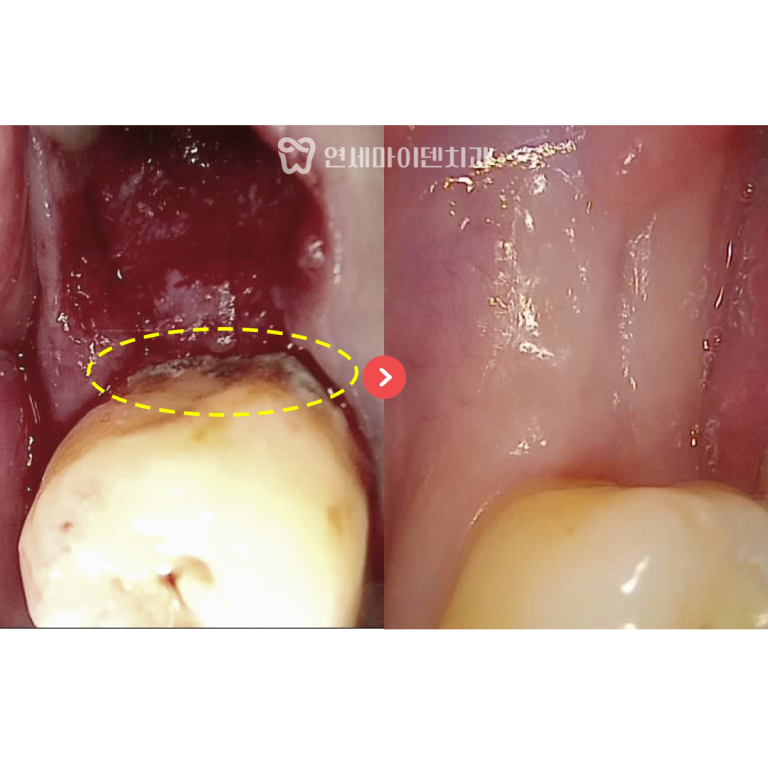 발치 즉시 임플란트 증례: 임플란트 불가능 진단