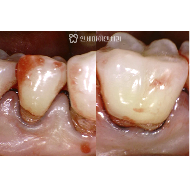 신경치료 성공 증례: 치경부 마모증