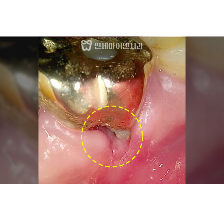 신경치료 성공 증례: 잇몸 염증 패임
