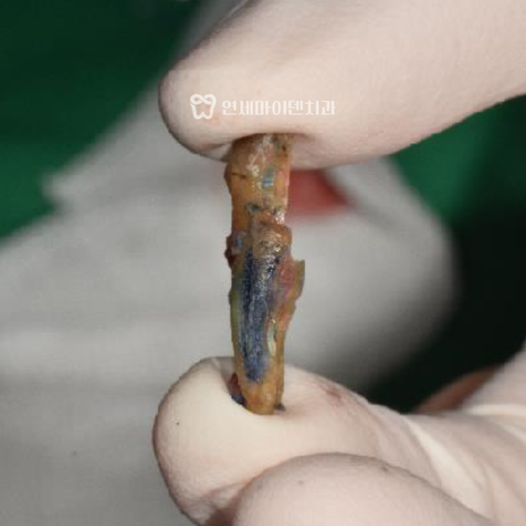 발치 즉시 임플란트 6년 증례: 크랙치아 진단 과정