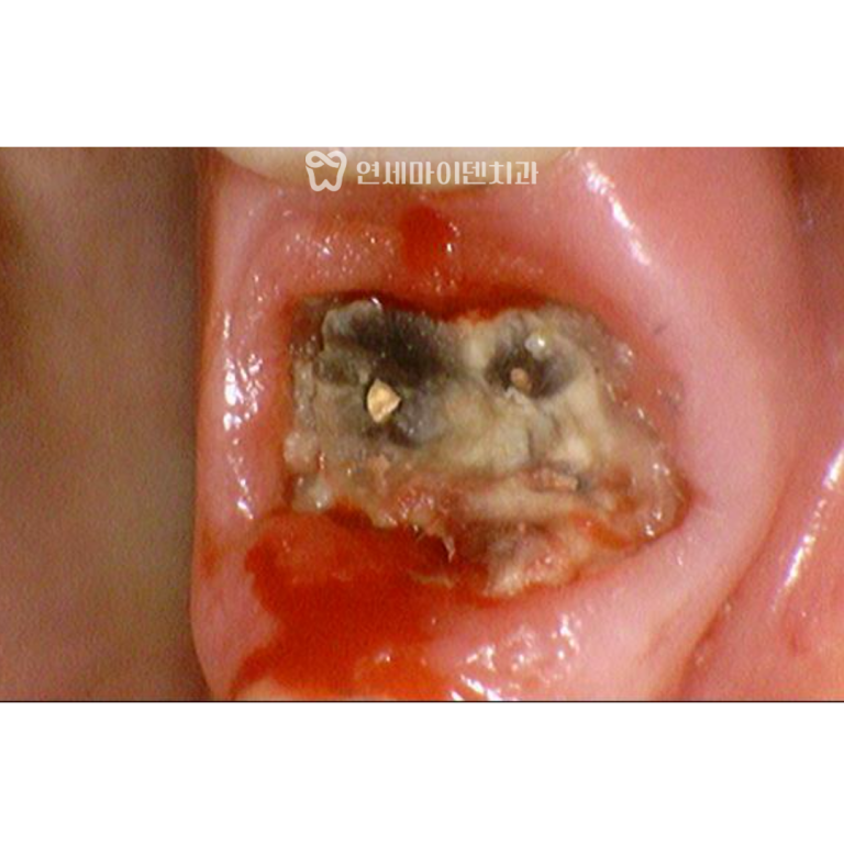 크라운, 레진, 치아보철물 수명과 교체시기