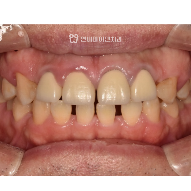 40대 치아교정 증례: 인비절라인 투명교정