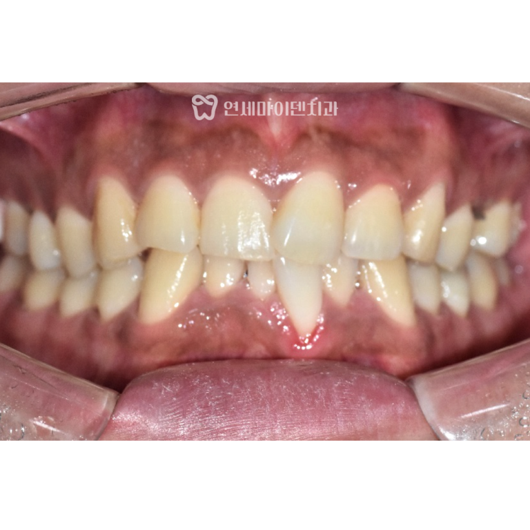 부러진 치아 비발치교정 증례: 보존과 협진