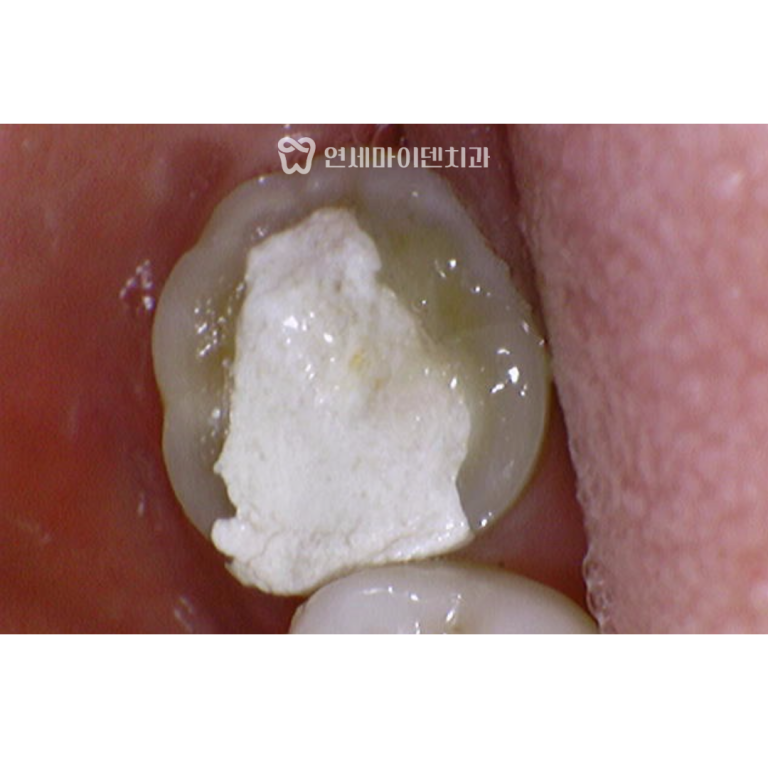 재신경치료 성공증례 : 신경치료 9번 실패