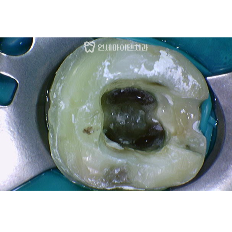 신경치료 1년 증례: 잇몸고름 뼈녹음