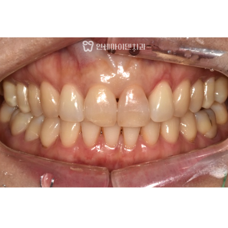 앞니 신경치료, 실활치미백 증례: 신경 석회화