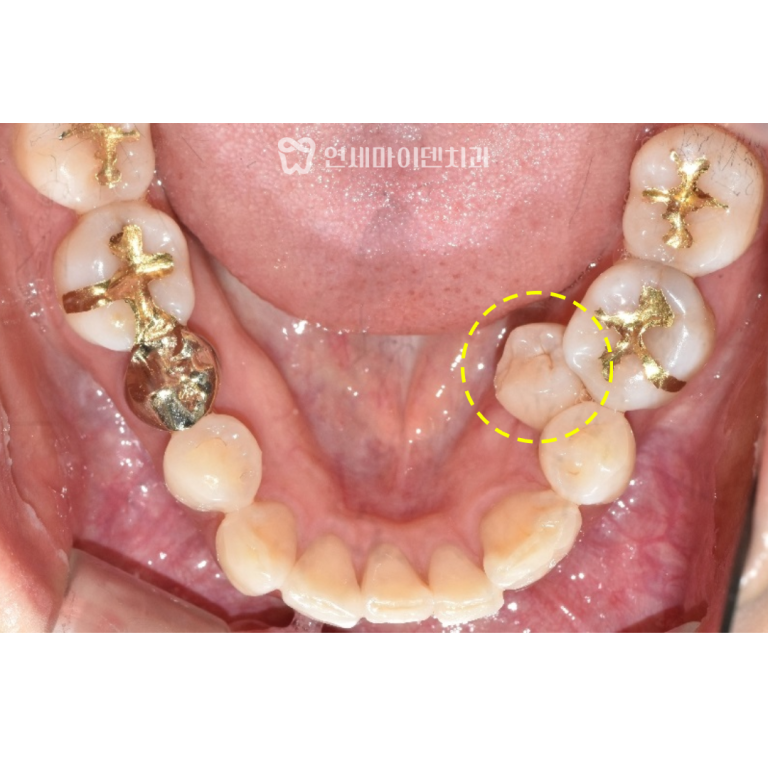 성인 발치교정 증례: 융합치 돌출입