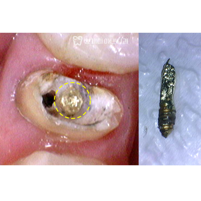 재신경치료 3년 증례: 치아기둥 포스트제거