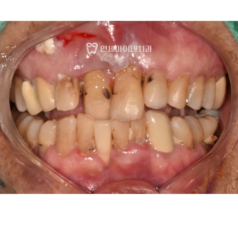 넘어져서 앞니 다쳤을 때 올바른 응급처치 방법