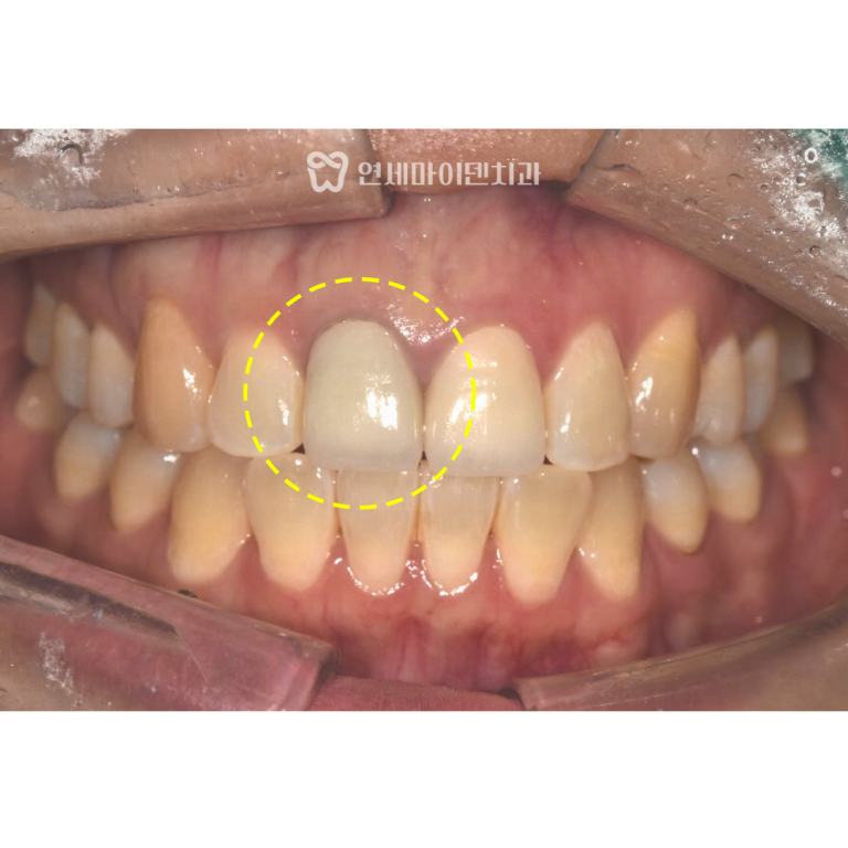 앞니 변색 재신경치료, 실활치미백 증례