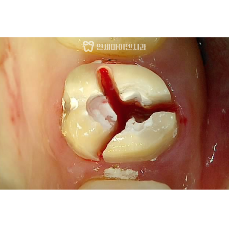 발치 즉시 임플란트 증례 : 신경치료 후 치아크랙