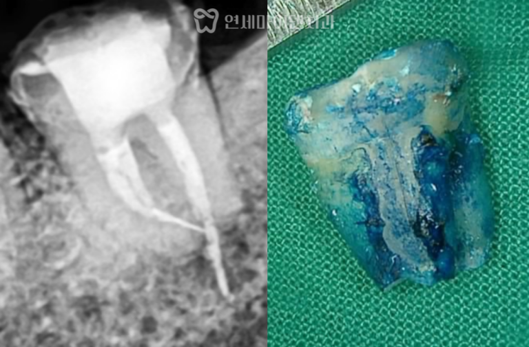 치아재식술 증례: 잇몸 고름