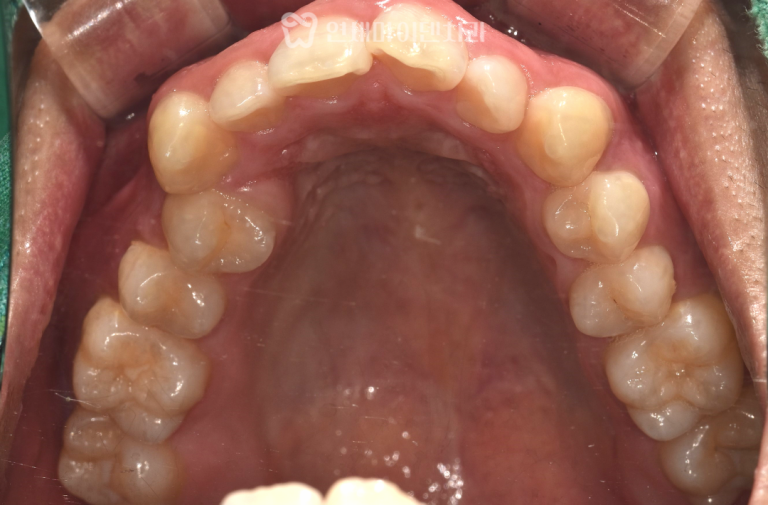 비발치 치아교정 증례: 15개월 완성