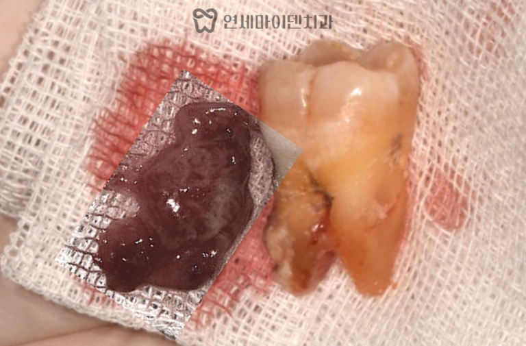 어금니 임플란트 증례: 치주질환 치료