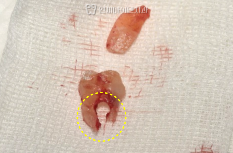 발치 즉시 임플란트 3년 증례: 치아 퍼포레이션