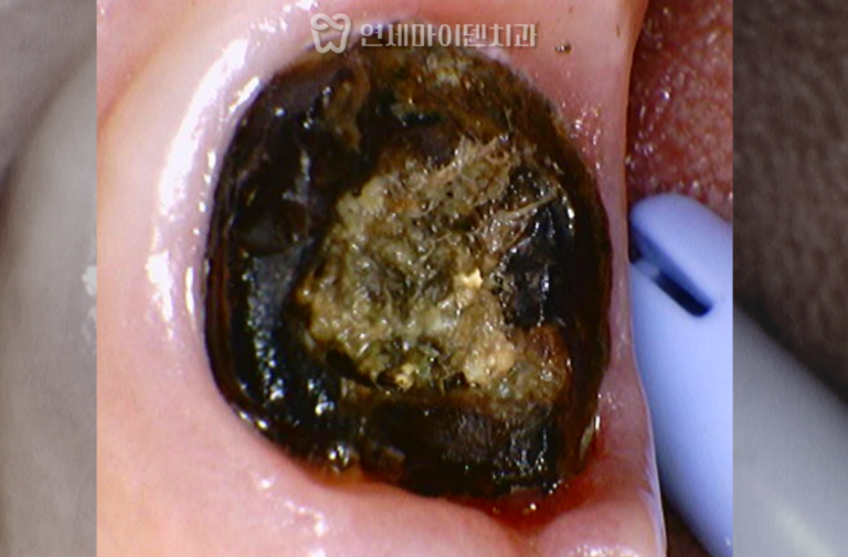 재신경치료&임플란트 증례: 해외 거주 환자