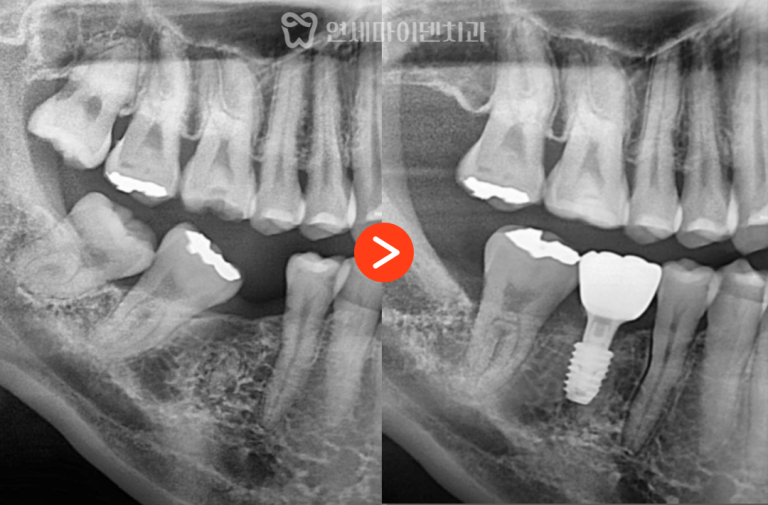 부분 치아교정 증례: 임플란트 협진 케이스
