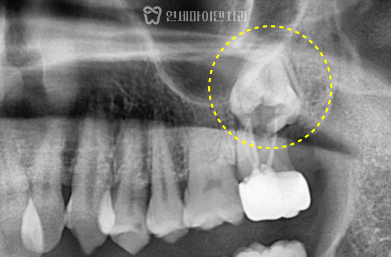 발치 즉시 임플란트 증례: 매복 사랑니 발치