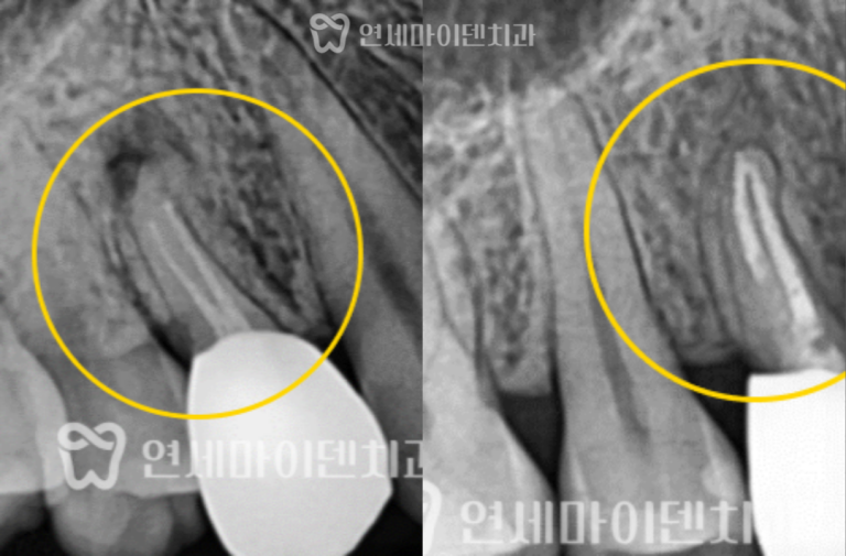 재신경치료 2년 증례: 타원 발치 진단