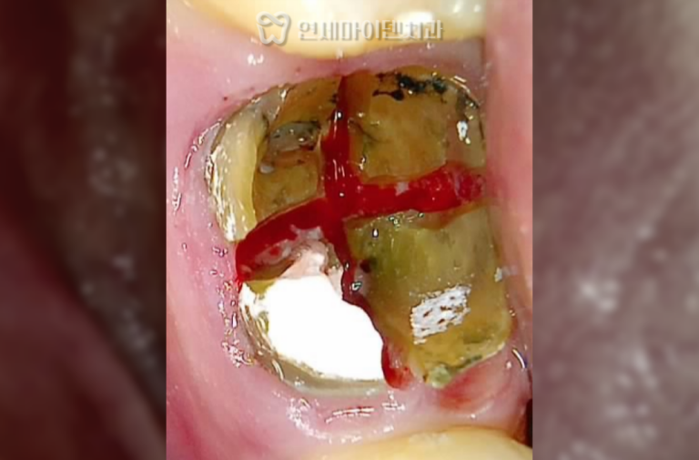 발치 즉시 임플란트 증례: 해외 출국 환자