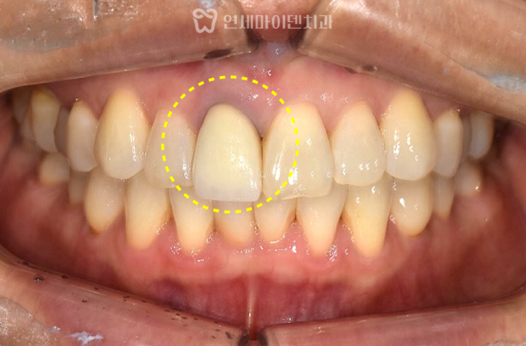 앞니 재신경치료 증례: 치근단 재수술