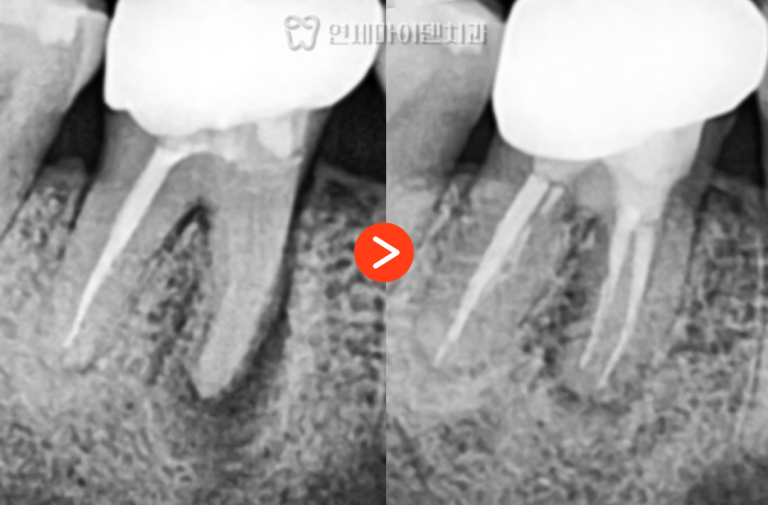 재신경치료 증례: 놓친 신경관