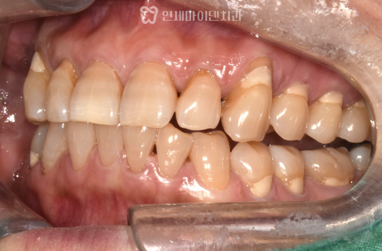 발치 즉시 임플란트 증례: 잇몸 퇴축