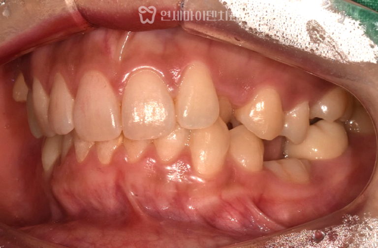 치아교정&임플란트 협진 증례: 1년 9개월