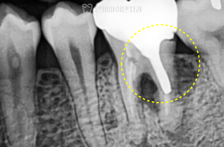 발치 즉시 임플란트 증례: 과도한 포스트