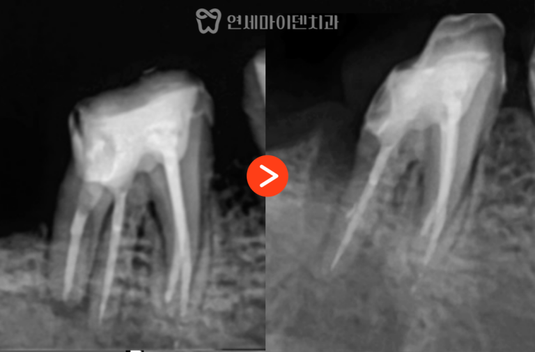 치근절제술 증례: 5년 경과