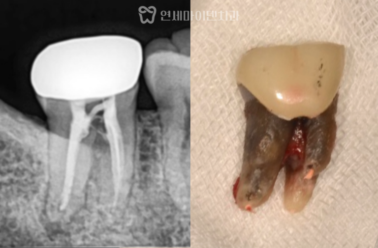 발치 즉시 임플란트 증례: One-Day Implant