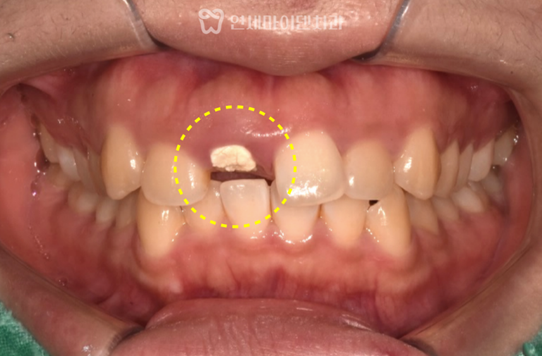 치아정출술 증례: 부러진 앞니
